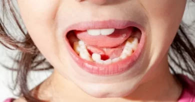 Enfants avec dents non-alignées
